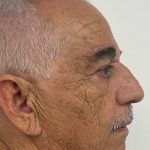Brow Lift Before & After Patient #3467