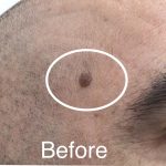 Mole Removal Before & After Patient #3514