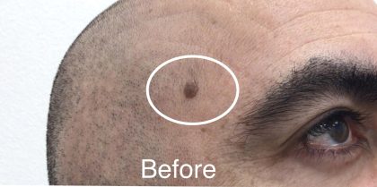 Mole Removal Before & After Patient #3514
