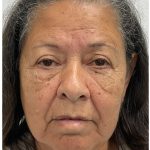 Lower Blepharoplasty Before & After Patient #3497
