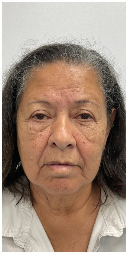 Lower Blepharoplasty Before & After Patient #3497
