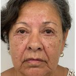Lower Blepharoplasty Before & After Patient #3497