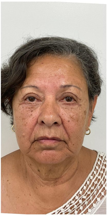 Lower Blepharoplasty Before & After Patient #3497