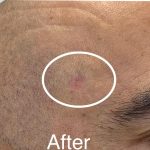 Mole Removal Before & After Patient #3514