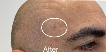 Mole Removal Before & After Patient #3514