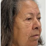 Lower Blepharoplasty Before & After Patient #3497