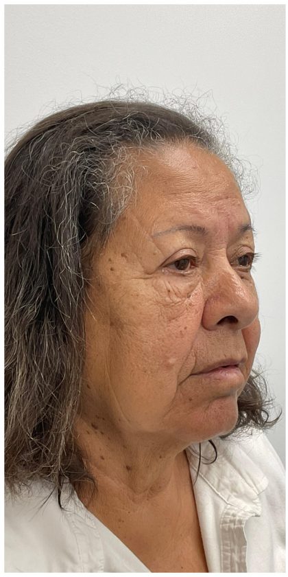 Lower Blepharoplasty Before & After Patient #3497
