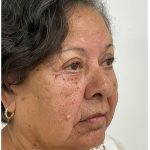 Lower Blepharoplasty Before & After Patient #3497