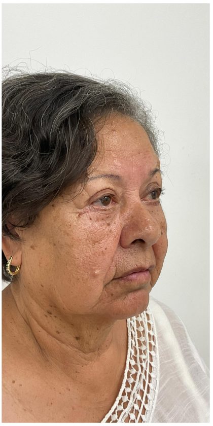 Lower Blepharoplasty Before & After Patient #3497