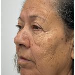 Lower Blepharoplasty Before & After Patient #3497