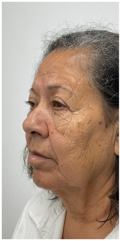 Lower Blepharoplasty Before & After Patient #3497