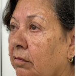 Lower Blepharoplasty Before & After Patient #3497