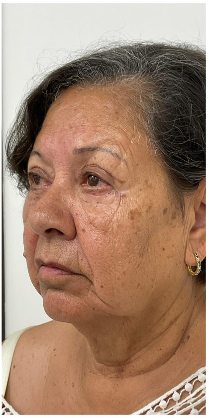 Lower Blepharoplasty Before & After Patient #3497