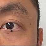 Mole Removal Before & After Patient #3532