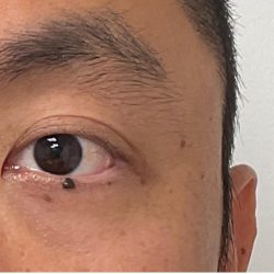Mole Removal Before & After Patient #3532