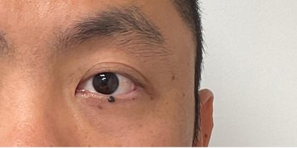 Mole Removal Before & After Patient #3532