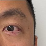 Mole Removal Before & After Patient #3532