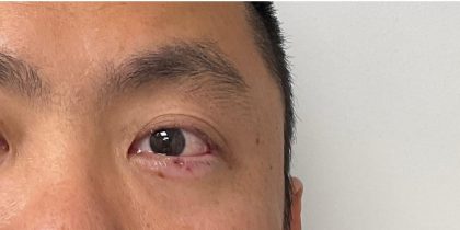 Mole Removal Before & After Patient #3532