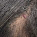 Mole Removal Before & After Patient #3545