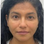 Facial Fillers Before & After Patient #3549
