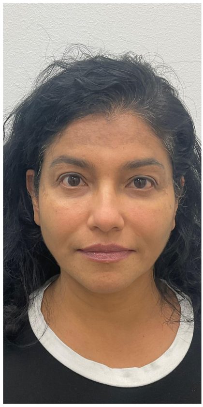 Facial Fillers Before & After Patient #3549