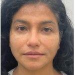 Facial Fillers Before & After Patient #3549