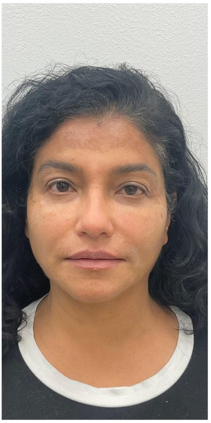 Facial Fillers Before & After Patient #3549