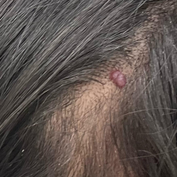 Mole Removal Before & After Patient #3545