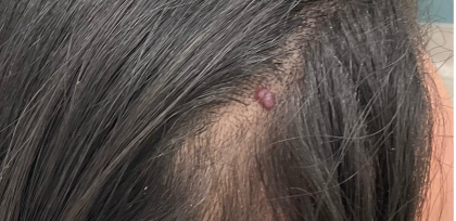 Mole Removal Before & After Patient #3545