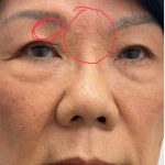 Syringoma Before & After Patient #3533