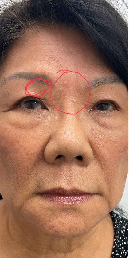 Syringoma Before & After Patient #3533