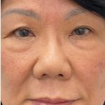 Syringoma Before & After Patient #3533