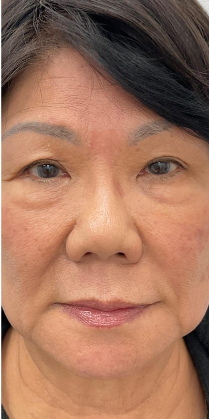 Syringoma Before & After Patient #3533