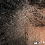 Mole Removal Before & After Patient #3545