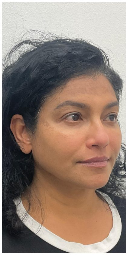 Facial Fillers Before & After Patient #3549