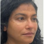 Facial Fillers Before & After Patient #3549