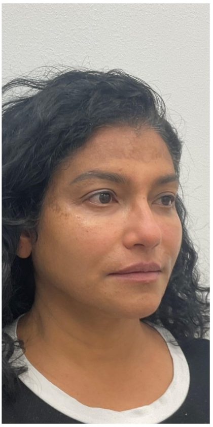 Facial Fillers Before & After Patient #3549