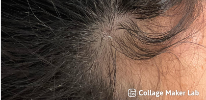 Mole Removal Before & After Patient #3545
