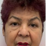 Upper Blepharoplasty Before & After Patient #3534