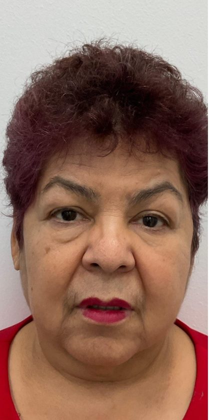 Upper Blepharoplasty Before & After Patient #3534