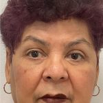 Upper Blepharoplasty Before & After Patient #3534