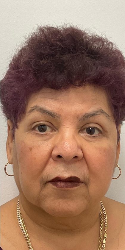 Upper Blepharoplasty Before & After Patient #3534