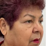 Upper Blepharoplasty Before & After Patient #3534