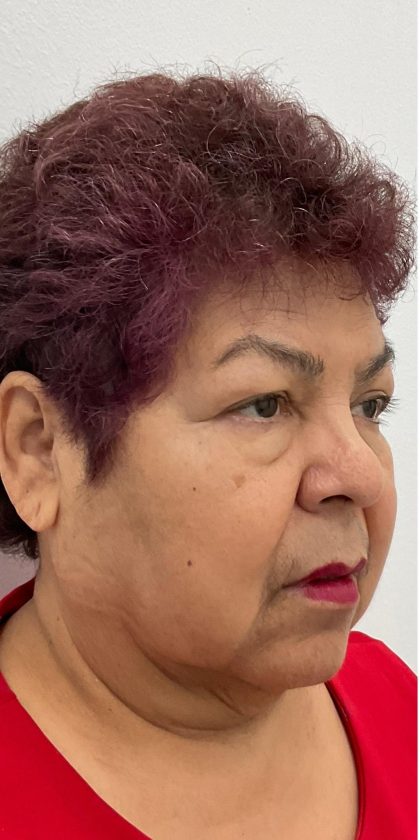 Upper Blepharoplasty Before & After Patient #3534