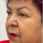 Upper Blepharoplasty Before & After Patient #3534
