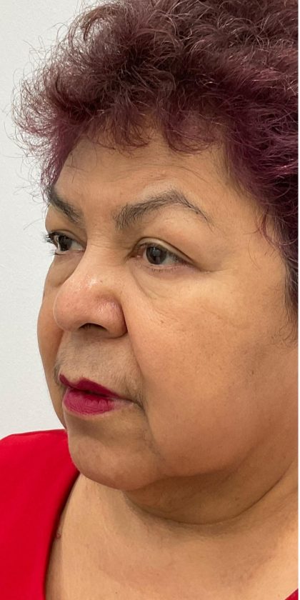 Upper Blepharoplasty Before & After Patient #3534