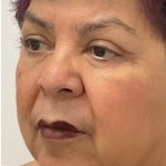 Upper Blepharoplasty Before & After Patient #3534