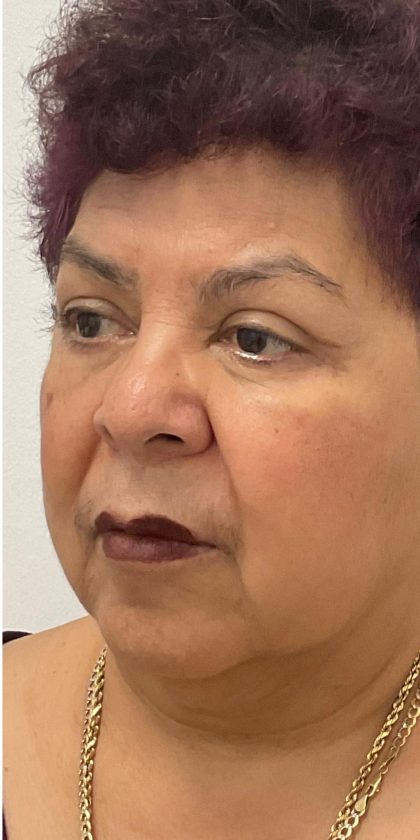 Upper Blepharoplasty Before & After Patient #3534