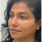 Facial Fillers Before & After Patient #3549