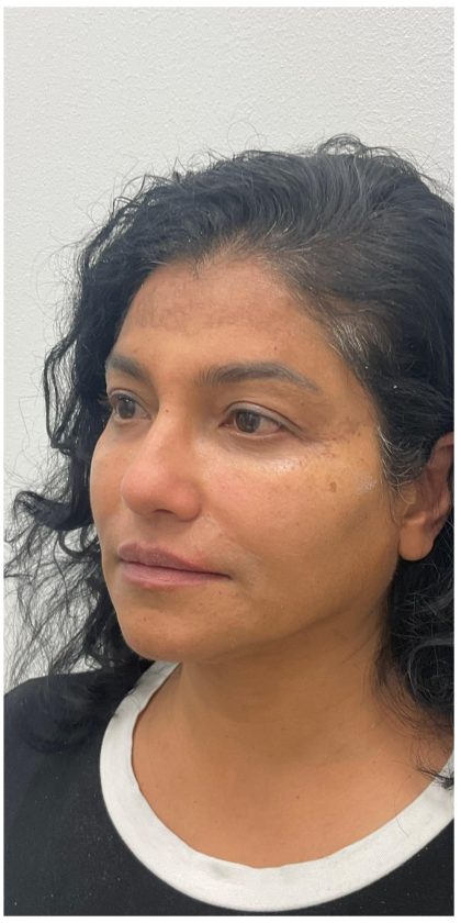 Facial Fillers Before & After Patient #3549